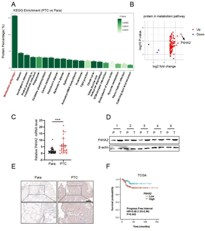 P4HA2 promotes the progression of papillary thyroid cancer by enhancing degradation of IκBα to activate NF-κB signaling pathway.