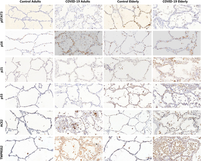 Ageing and dysregulated lung immune responses in fatal COVID-19.