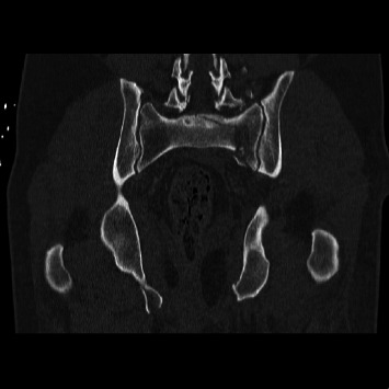 Outcomes of Percutaneous Versus Open Lumbopelvic Fixation of Spinopelvic Dissociation.