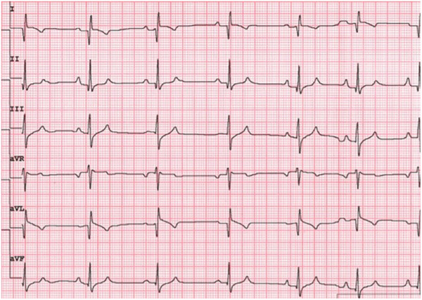 Transient Extreme Axis Deviation in a Dog With Diabetic Ketoacidosis.