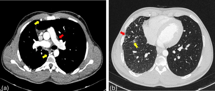 Breathing With Half a Pulmonary Circuit: Three Cases of Unilateral Pulmonary Artery Agenesis.