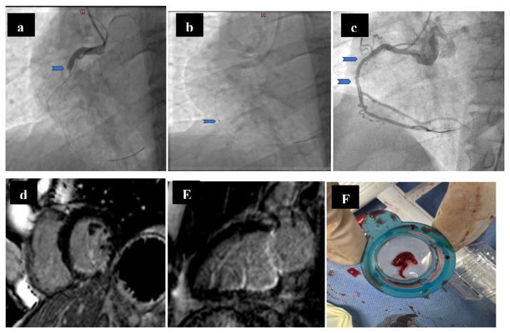 Impact of Aspiration Thrombectomy on Microvascular Obstruction in Patients With ST-segment Elevation Myocardial Infarction.