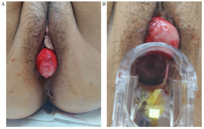Incarcerated prolapsed ureterocele complicated by postoperative acute pyelonephritis: a case report.