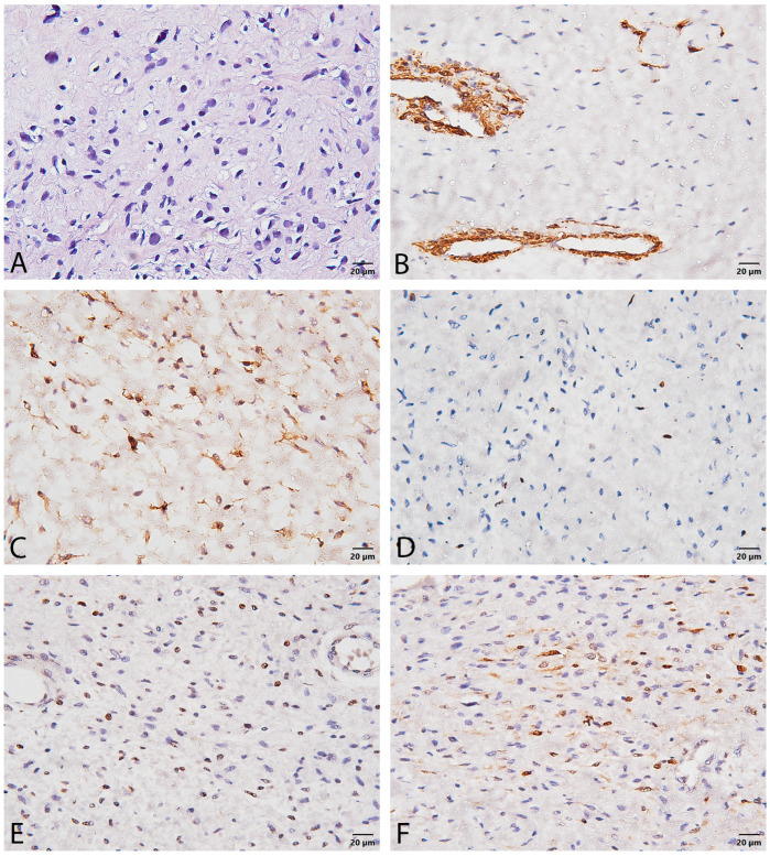 Giant Atypical Neurofibroma of the Calf in Neurofibromatosis Type 1: Case Report and Literature Review.