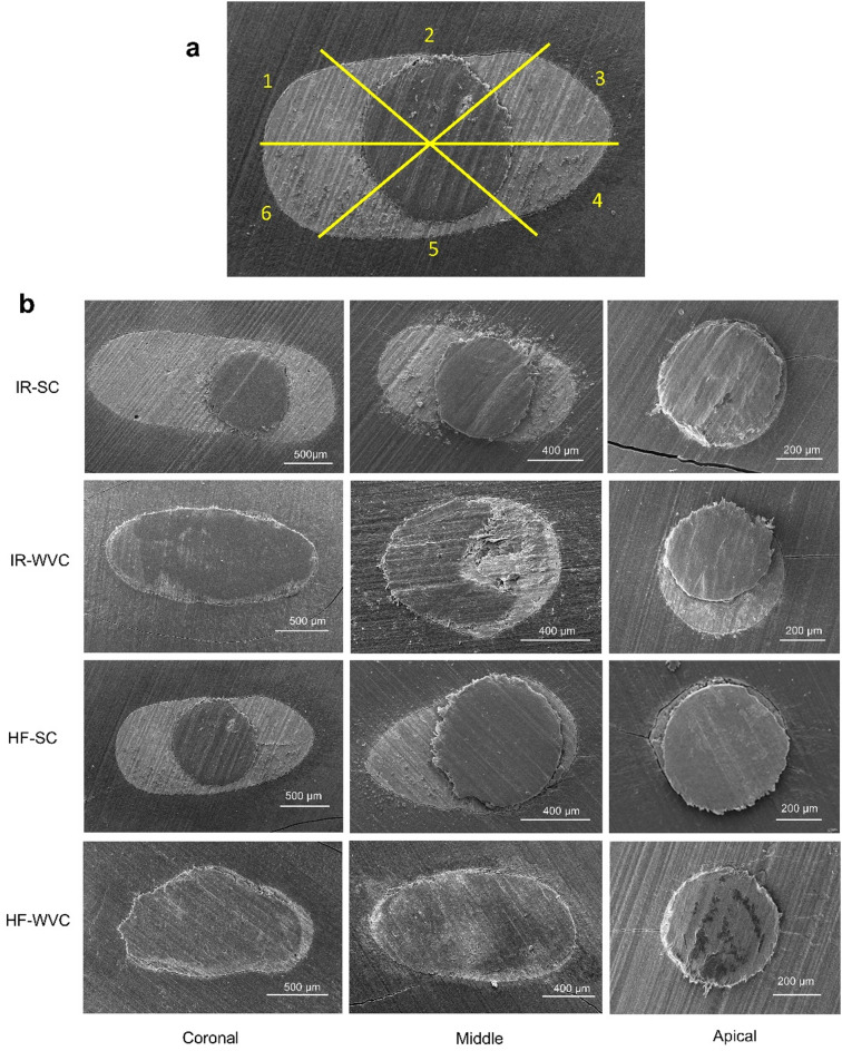 Marginal adaptation of heat and non-heat compatible bioceramic sealers in warm obturation: an in vitro SEM study.