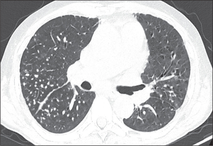 Relationship between the computed tomography pattern and vaccination status in individuals with COVID-19.