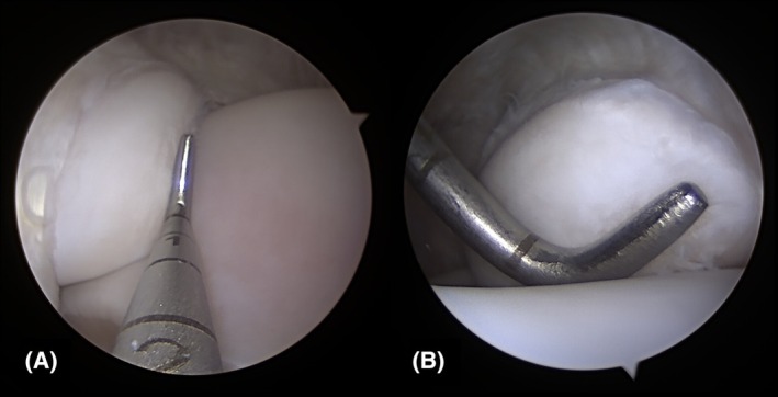 Comparison of a dorsolateral approach and a dorsomedial approach to access the medial malleolus of the distal tibia in horses.
