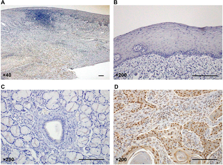 Total m6A RNA levels and VIRMA expression as potential diagnostic and prognostic markers in oral squamous cell carcinoma.