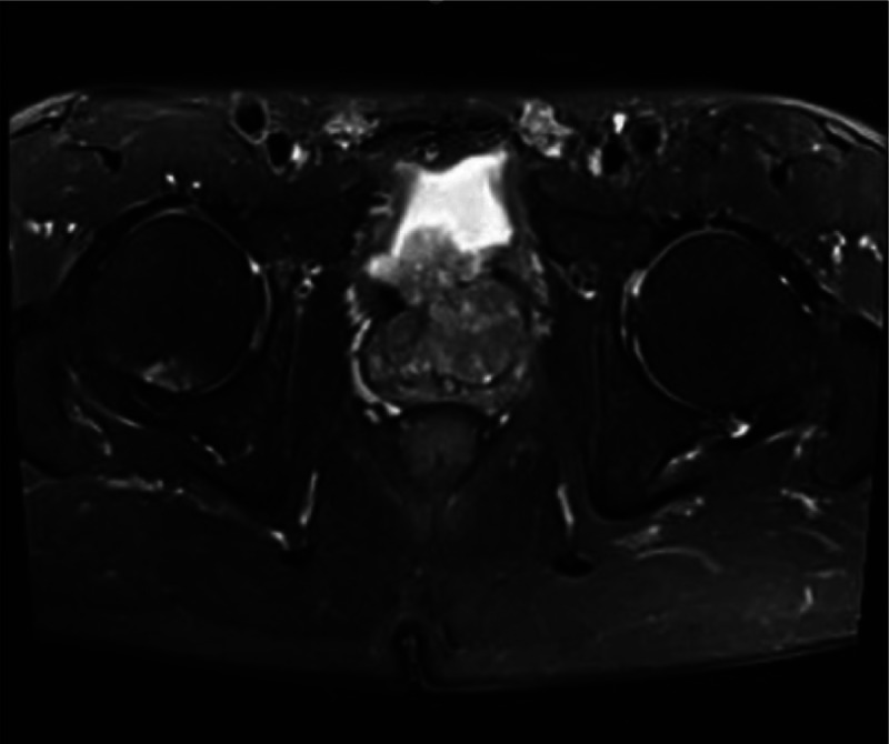 Emphasis on the management of embedded capsular hyperplasia nodules associated with benign prostatic hyperplasia.