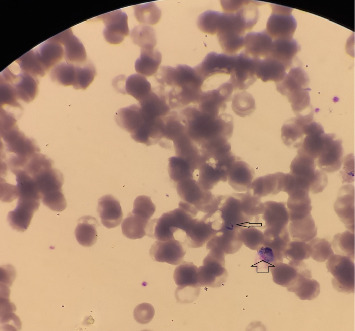 A Rare Presentation of <i>Plasmodium vivax</i> Malaria: Pancytopenia due to Hemophagocytic Syndrome in a Pregnant Woman.