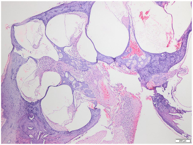 Preventive Effect of Controlled-Release Dexamethasone on Cochlear Ossification in Meningitis Model.