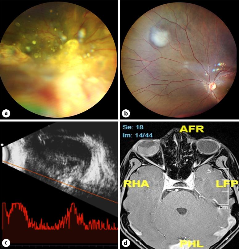 Late-Onset Bilateral Retinoblastoma in Adolescence with Successful Globe Salvage.