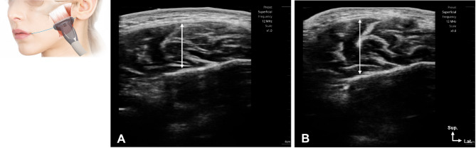 Adaptations of bite force and masseter muscle thickness to high-intensity physical training in professional athletes: a comparative cross-sectional study.