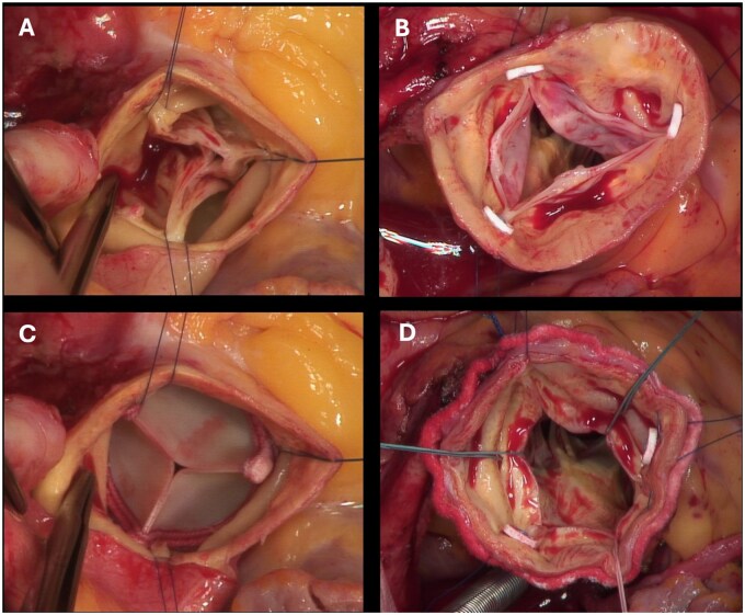 Promising early outcomes in surgical aortic valve replacement utilizing the rapid deployment approach for isolated aortic valve regurgitation.