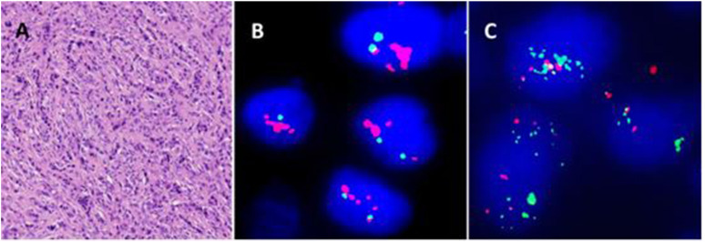 The implications of abnormal signal patterns of break-apart FISH probes used in the diagnosis of bone and soft tissue tumours.