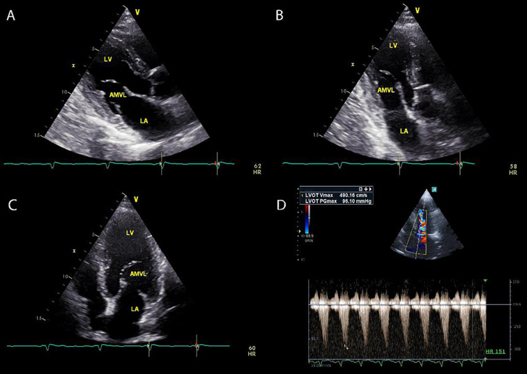An Unusual Etiology of Presyncopal Episodes: Dynamic Left Ventricular Outflow Tract Obstruction Secondary to an Elongated Anterior Mitral Valve Leaflet.