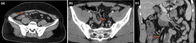 Evaluation of computed tomography (CT) appendicitis score and laboratory parameters in acute appendicitis with and without CT-detected appendicolith.