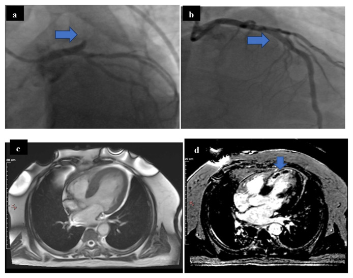 Impact of Aspiration Thrombectomy on Microvascular Obstruction in Patients With ST-segment Elevation Myocardial Infarction.