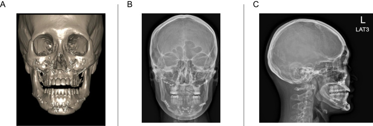Micro-Focused Ultrasound on an Individual with Titanium Facial Implants: A Case Report.