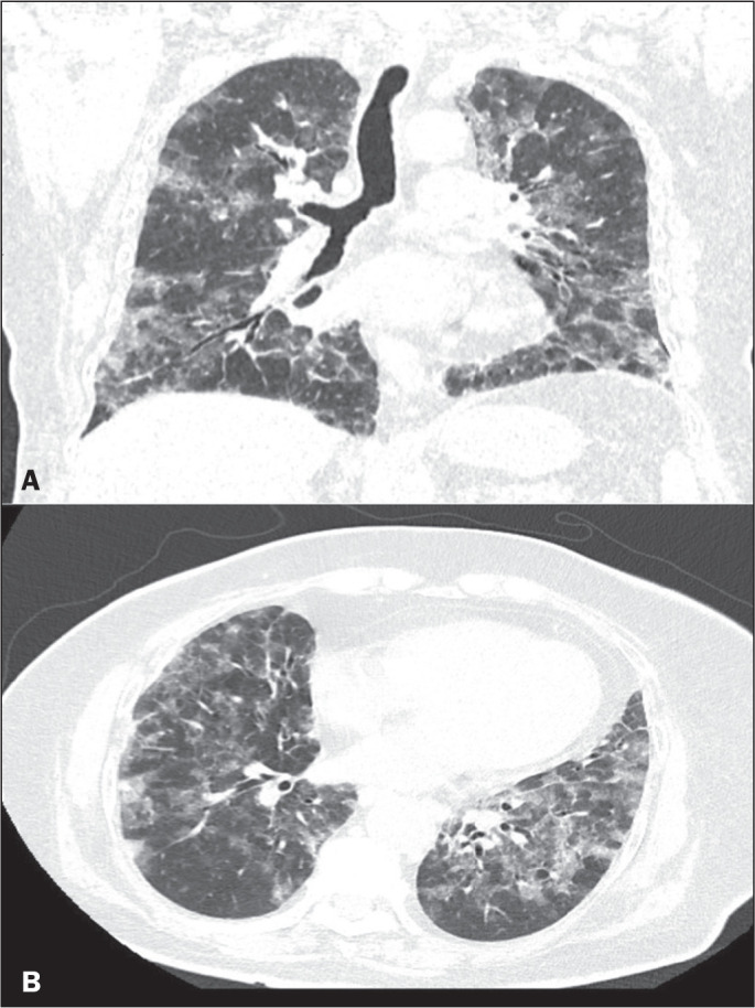 Relationship between the computed tomography pattern and vaccination status in individuals with COVID-19.