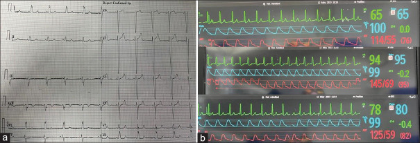 Rate-dependent reversion of rhythm to sinus in a known case of left bundle branch block: A pleasant surprise.