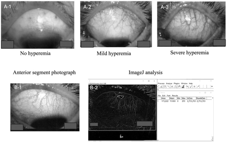 Impact of Preoperative Conjunctival Vascular Area on Surgical Outcomes in Trabeculectomy with Mitomycin C for Glaucoma: A Comprehensive Analysis.