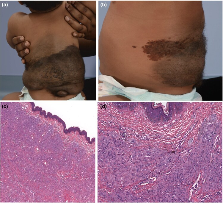 Congenital melanocytic naevi initiated by BRAF fusion oncogene with firmness, pruritus and desmoplastic stroma.