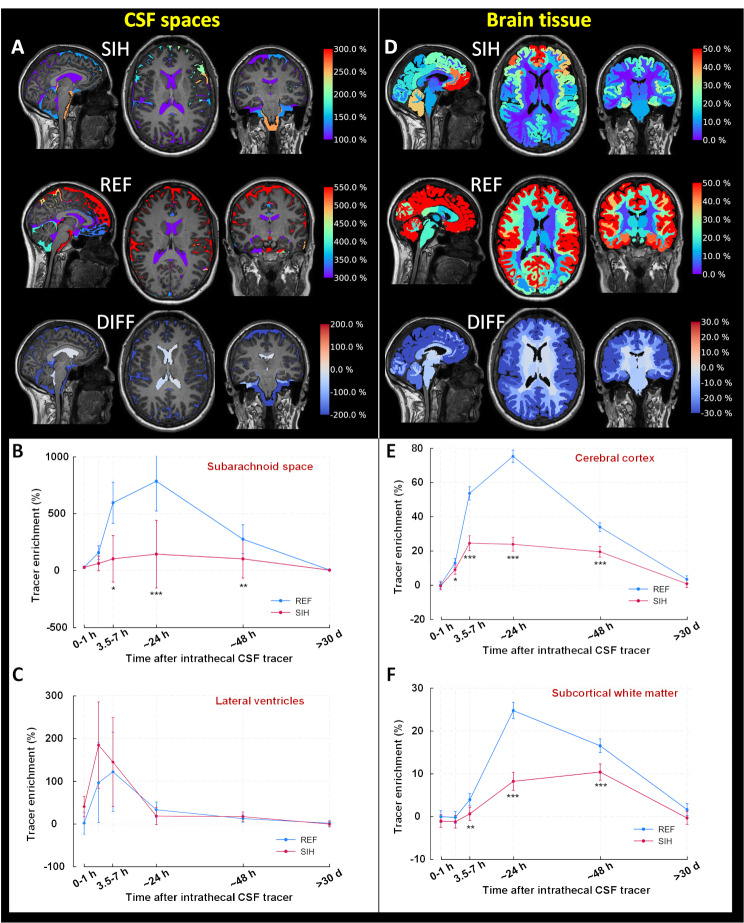 Altered brain fluid dynamics in spontaneous intracranial hypotension.