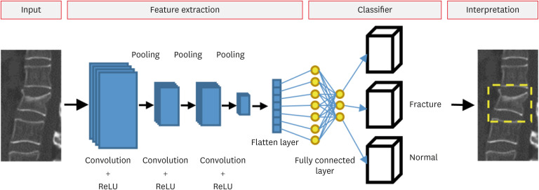 Advancing Spine Fracture Detection: The Role of Artificial Intelligence in Clinical Practice.