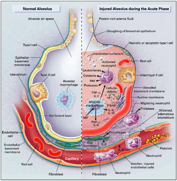 Pediatric Acute Respiratory Distress Syndrome Updates in the Light of the PALICC-2 Guidelines.