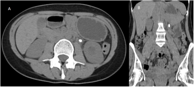 Spontaneous retrograde migration of a ureteric calculus: a rare phenomenon.