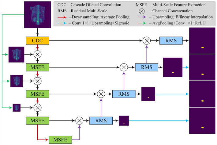 MSA-Net: a multi-scale and adversarial learning network for segmenting bone metastases in low-resolution SPECT imaging.