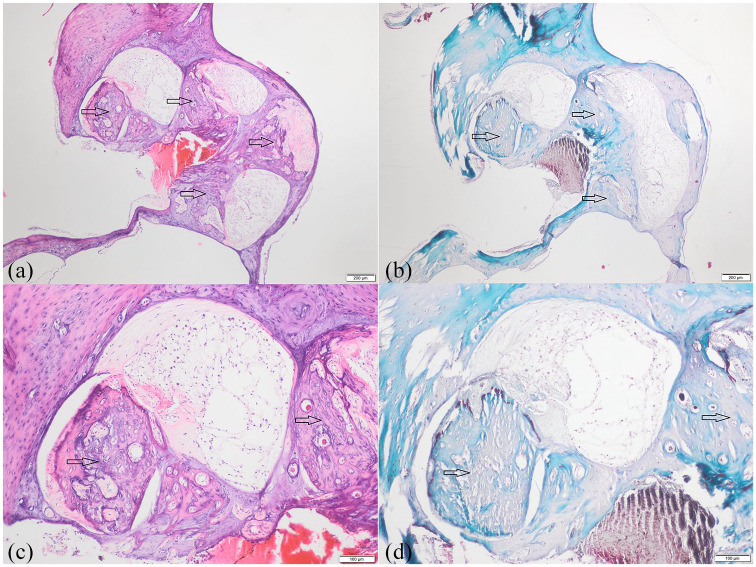 Preventive Effect of Controlled-Release Dexamethasone on Cochlear Ossification in Meningitis Model.