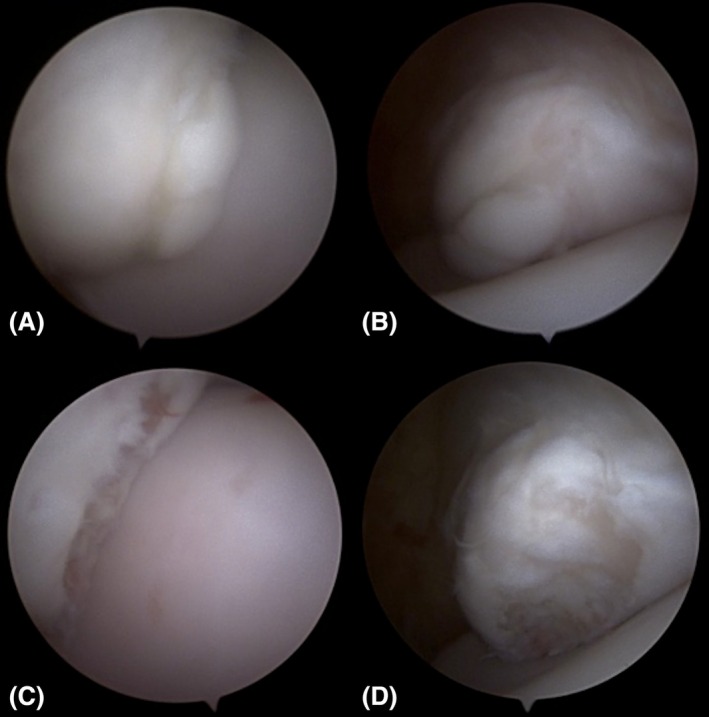 Comparison of a dorsolateral approach and a dorsomedial approach to access the medial malleolus of the distal tibia in horses.