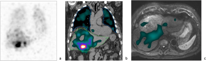 Assessment and clinical relevance of pulmonary shunt on <sup>166</sup>Ho-Scout Imaging in hepatocellular carcinoma.