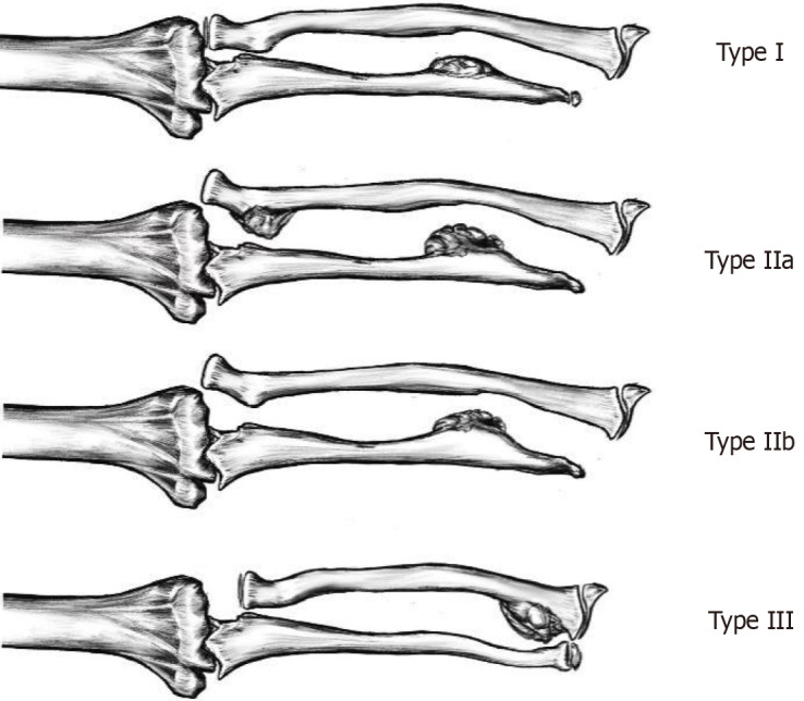 Ulnar lengthening in the treatment of forearm deformity caused by hereditary multiple exostoses in children.