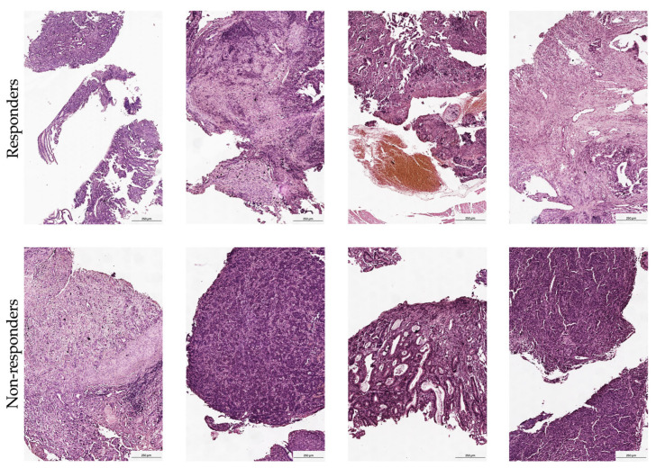 PD-1-Positive CD8+ T Cells and PD-1-Positive FoxP3+ Cells in Tumor Microenvironment Predict Response to Neoadjuvant Chemoimmunotherapy in Gastric Cancer Patients.