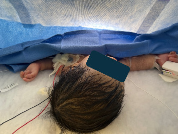 Infant Spinal Anesthesia for Urologic Surgery in a Patient With Epidermolysis Bullosa.