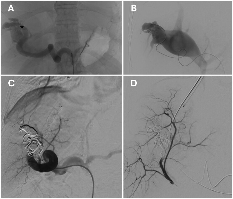 Hepatic barrage to high-flow, intra-hepatic arteroportal fistulas requiring combined interventional approach.