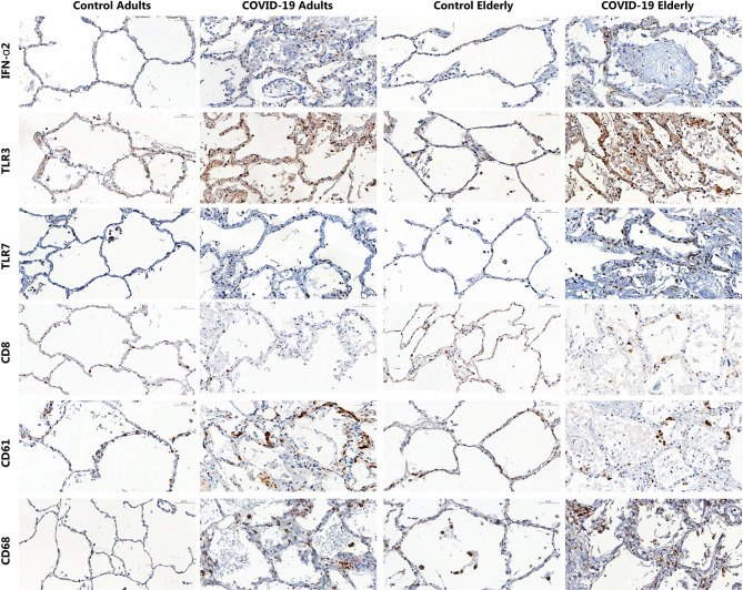 Ageing and dysregulated lung immune responses in fatal COVID-19.