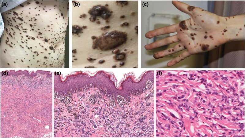 Congenital melanocytic naevi initiated by BRAF fusion oncogene with firmness, pruritus and desmoplastic stroma.