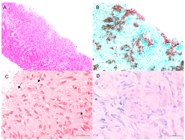 The Diagnostic Challenges of Disseminated Nocardiosis in a Post-Renal Transplant Patient: A Case Report.