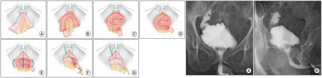 Totally intracorporeal ileal neobladder following robot-assisted radical cystectomy in male patients using the Juntendo technique: Initial experience.