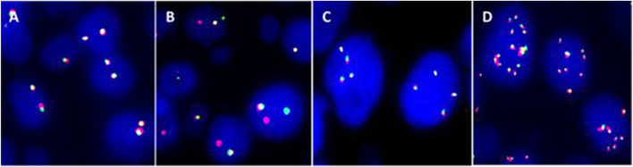 The implications of abnormal signal patterns of break-apart FISH probes used in the diagnosis of bone and soft tissue tumours.