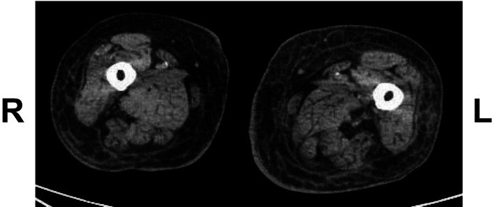 <i>Listeria monocytogenes</i> bacteremia accompanied by skin lesions on the legs.