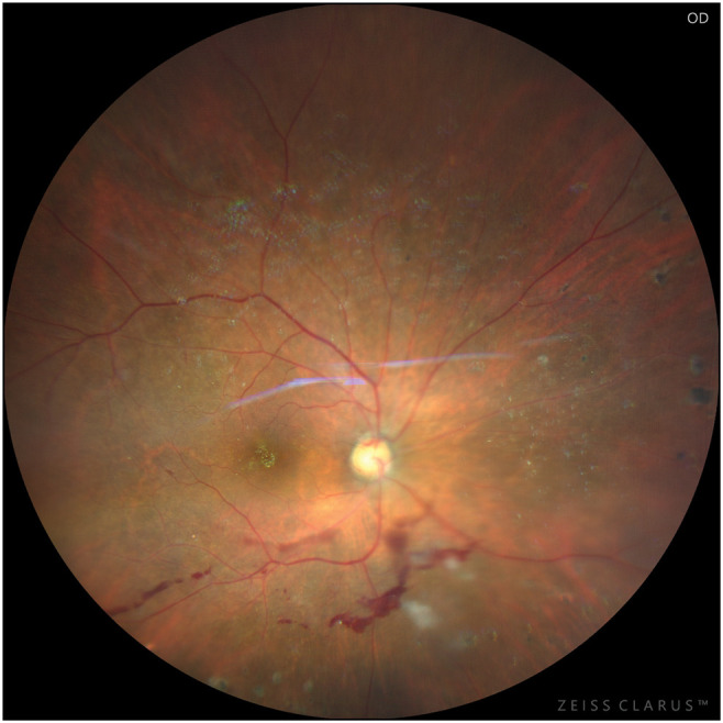 Proliferative Diabetic Retinopathy in Nigerians: Treatment Methods, Visual Outcomes, and Predictors of Poor Outcomes.