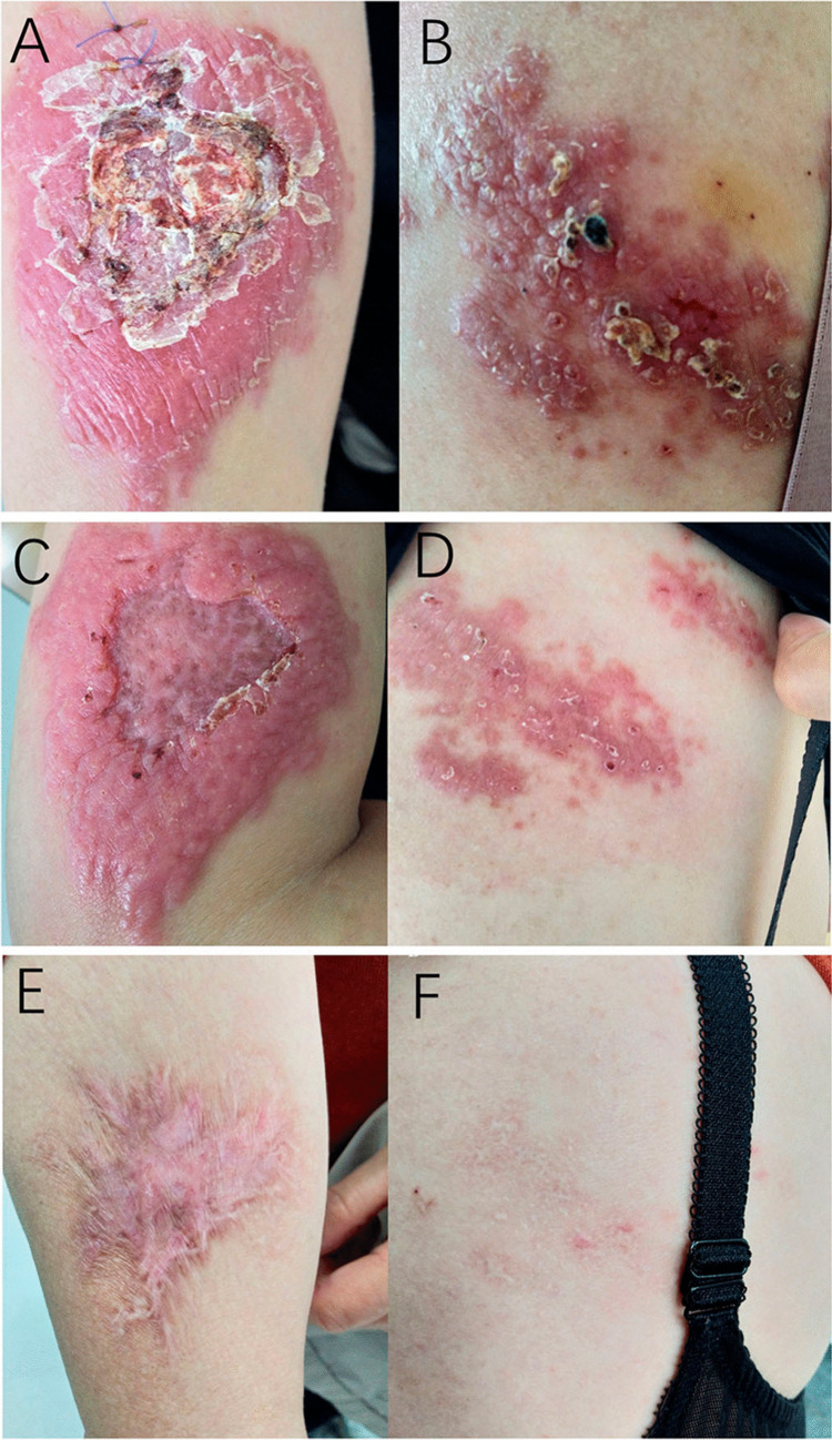 Integrated diagnosis and successful treatment of imported old world cutaneous leishmaniasis with intralesional sodium stibogluconate in china: a case report.