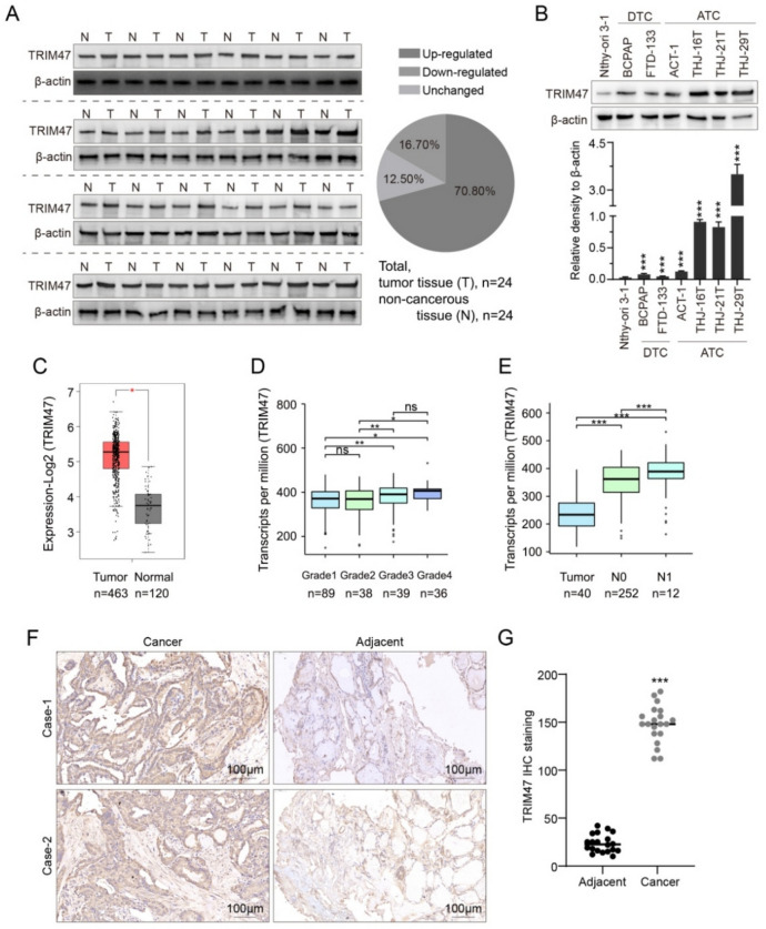 Tripartite motif 47 promotes the development of thyroid carcinoma through ADAR ubiquitination.