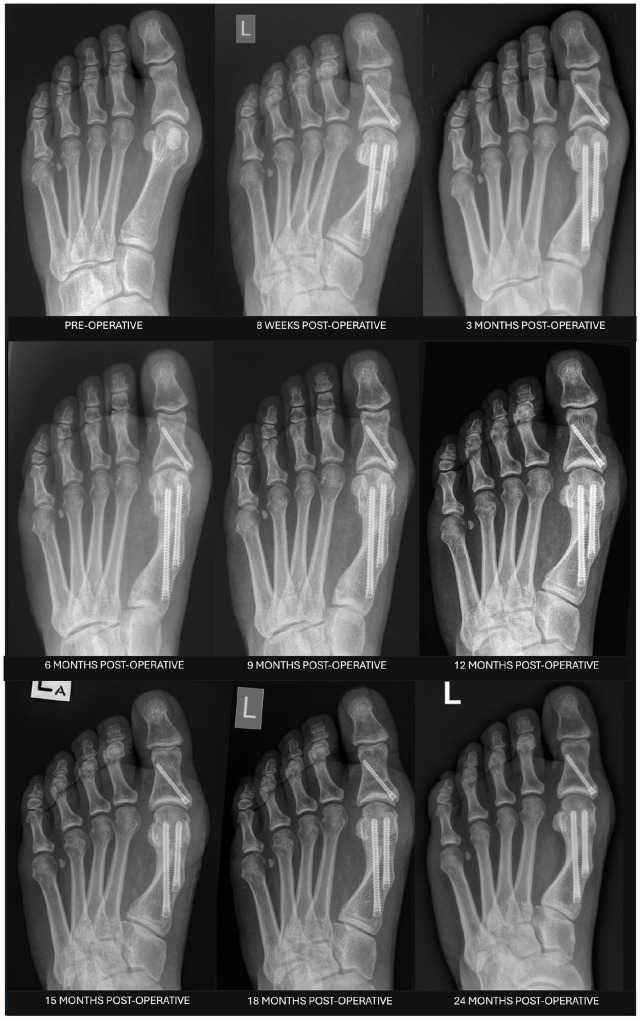 Preliminary Radiographic Classification of First Metatarsal Osteotomy Healing Following Minimally Invasive Hallux Valgus Surgery.