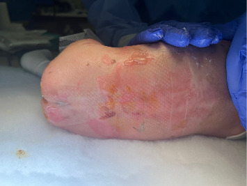 Infant Spinal Anesthesia for Urologic Surgery in a Patient With Epidermolysis Bullosa.